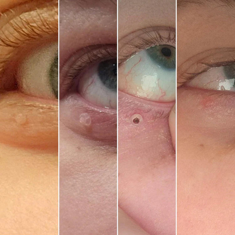 WipeOff® – Fast & Effective Wart Remover (Buy 1 Get 2 + Free Shipping)