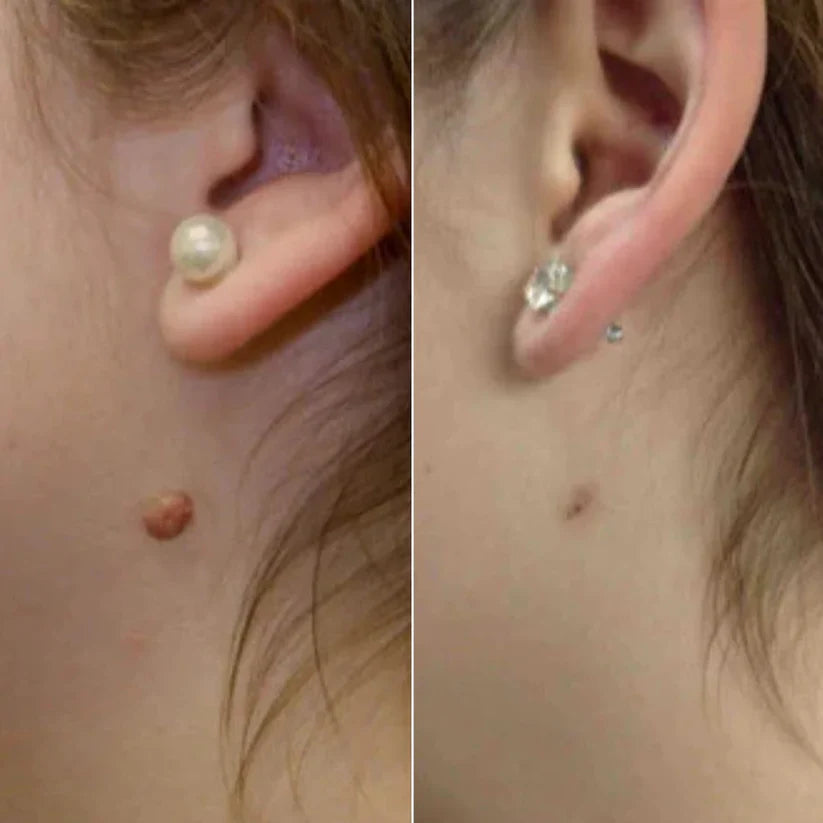 WipeOff® – Fast & Effective Wart Remover (Buy 1 Get 2 + Free Shipping)