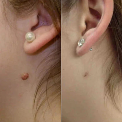 WipeOff® – Fast & Effective Wart Remover (Buy 1 Get 2 + Free Shipping)